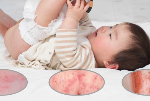 Plenični izpuščaj