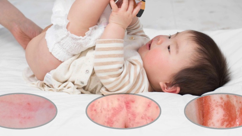 Plenični izpuščaj