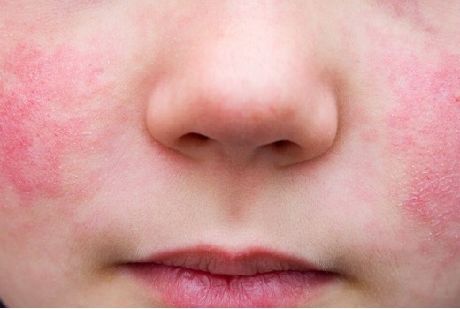 5 otroška bolezen – zakaj je nevarna predvsem za nosečnice