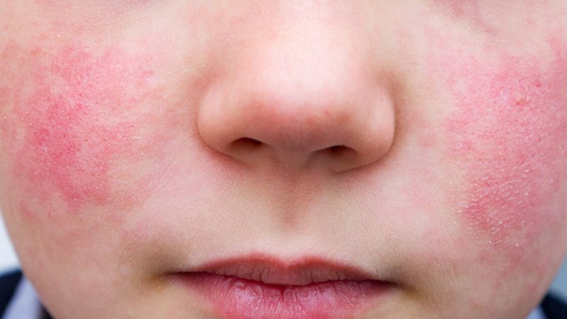 5 otroška bolezen – zakaj je nevarna predvsem za nosečnice