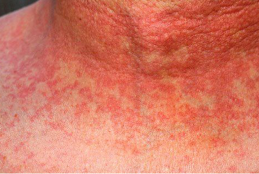 Škrlatinka, kako prepoznati to bolezen in kako ukrepati