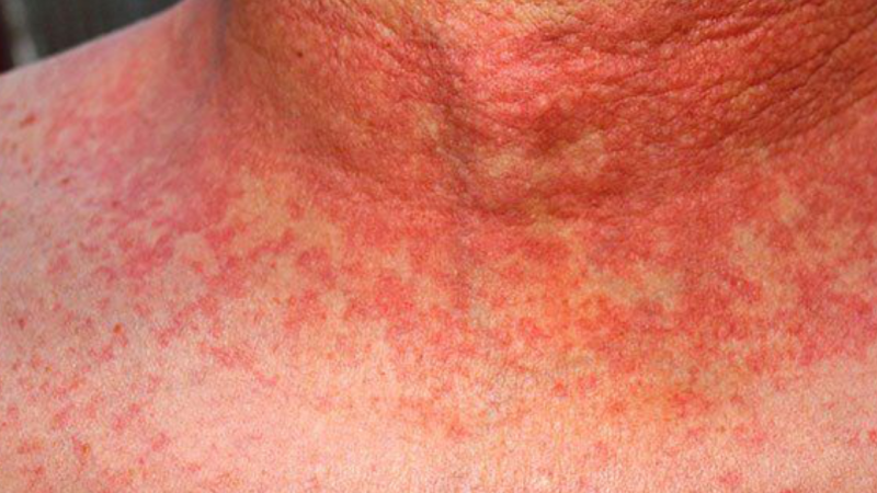 Škrlatinka, kako prepoznati to bolezen in kako ukrepati