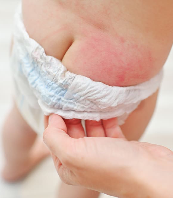 Plenični izpuščaj zaradi plenice Plenični izpuščaj zaradi plenice