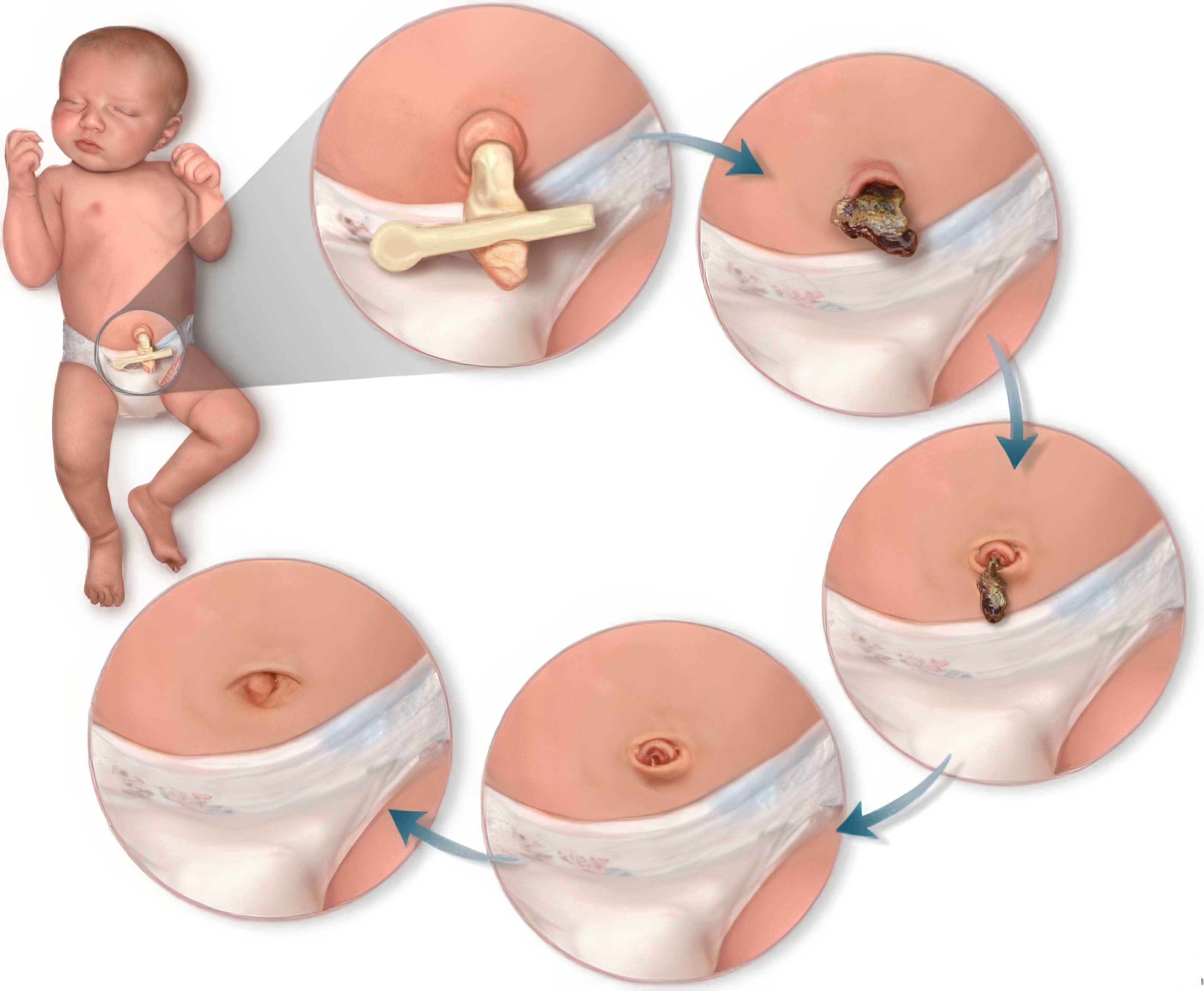 Postopek sušenja popkovine Postopek sušenja popkovine